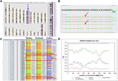 Case report: Paternal uniparental disomy on chromosome 7 and homozygous SUGCT mutation in a fetus with overweight after birth